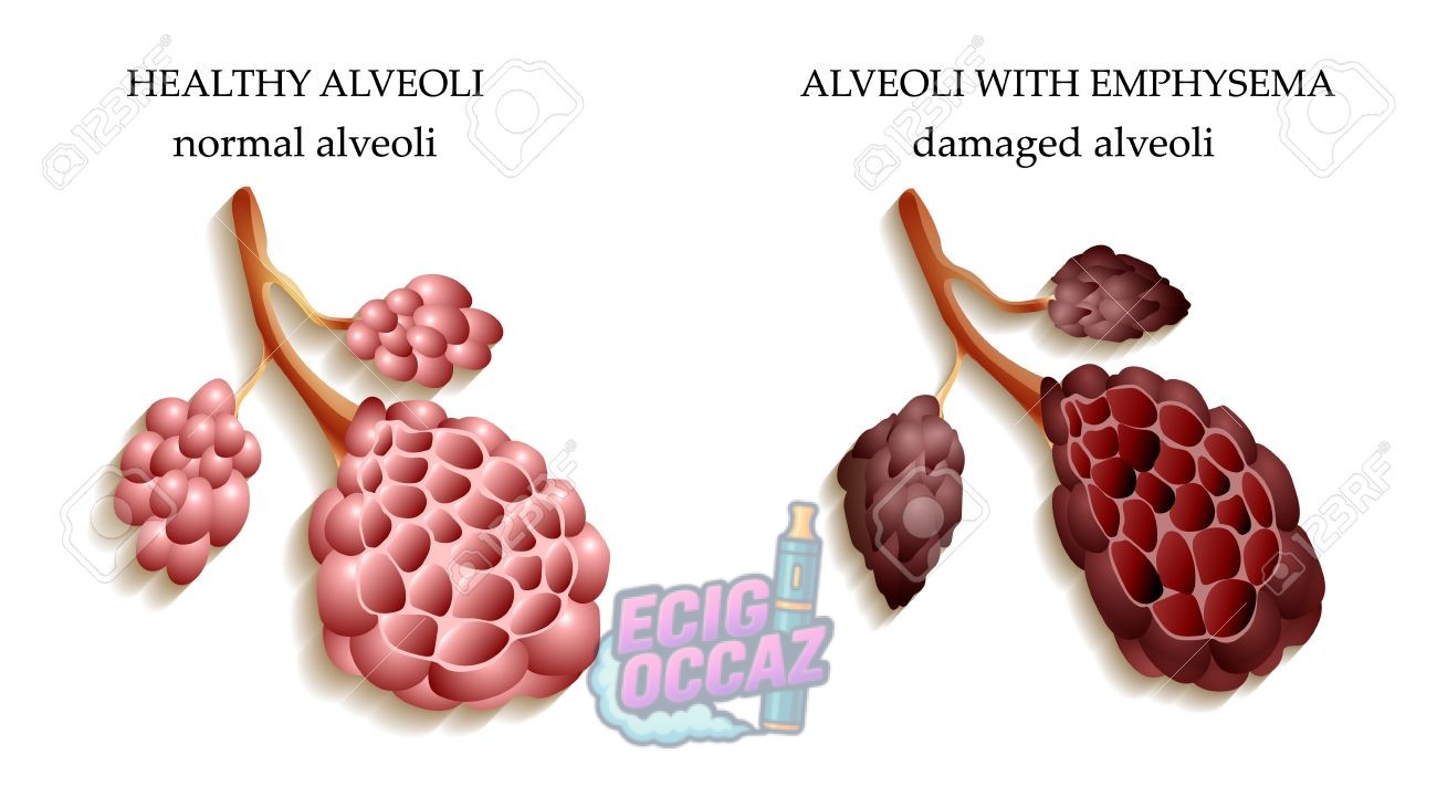 découvrez les principaux dangers pour la santé liés au tabagisme : risques de cancer, maladies cardiovasculaires, troubles respiratoires et autres conséquences graves pour les fumeurs.